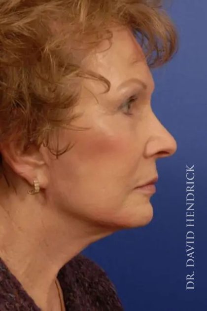 Facelift Before & After Patient #7818