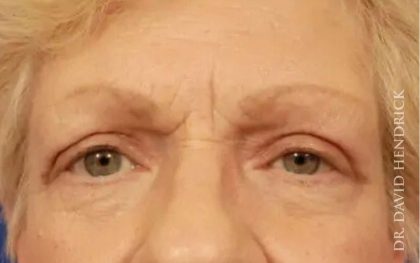 Brow Lift Before & After Patient #7723