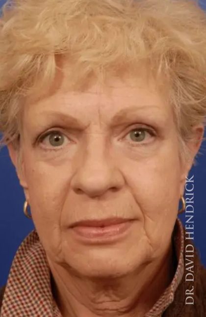 Brow Lift Before & After Patient #7723