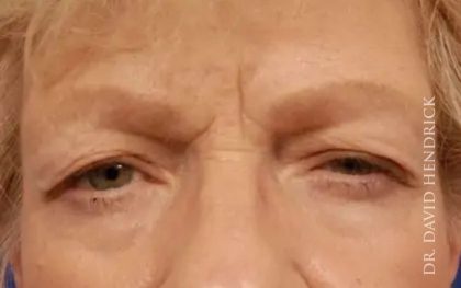 Brow Lift Before & After Patient #7723
