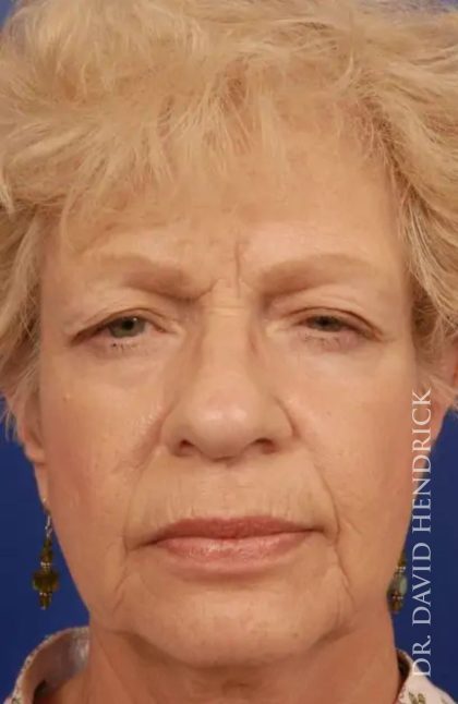 Brow Lift Before & After Patient #7723