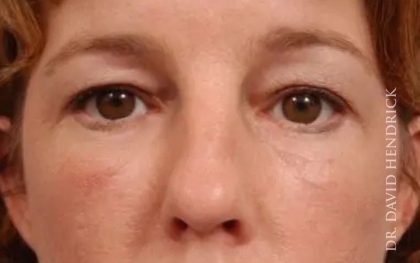 Brow Lift Before & After Patient #7728