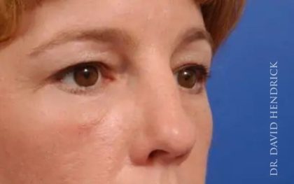 Brow Lift Before & After Patient #7728