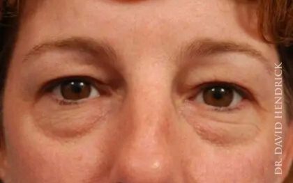 Brow Lift Before & After Patient #7728