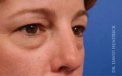 Brow Lift Before & After Patient #7728