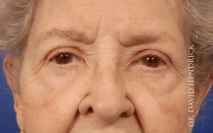 Brow Lift Before & After Patient #7763