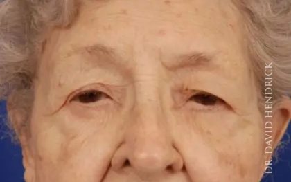 Brow Lift Before & After Patient #7763