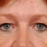 Blepharoplasty Before & After Patient #7860