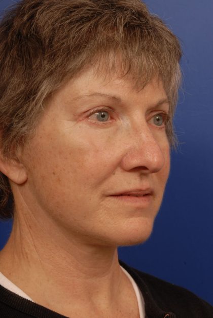 Facelift Before & After Patient #7850