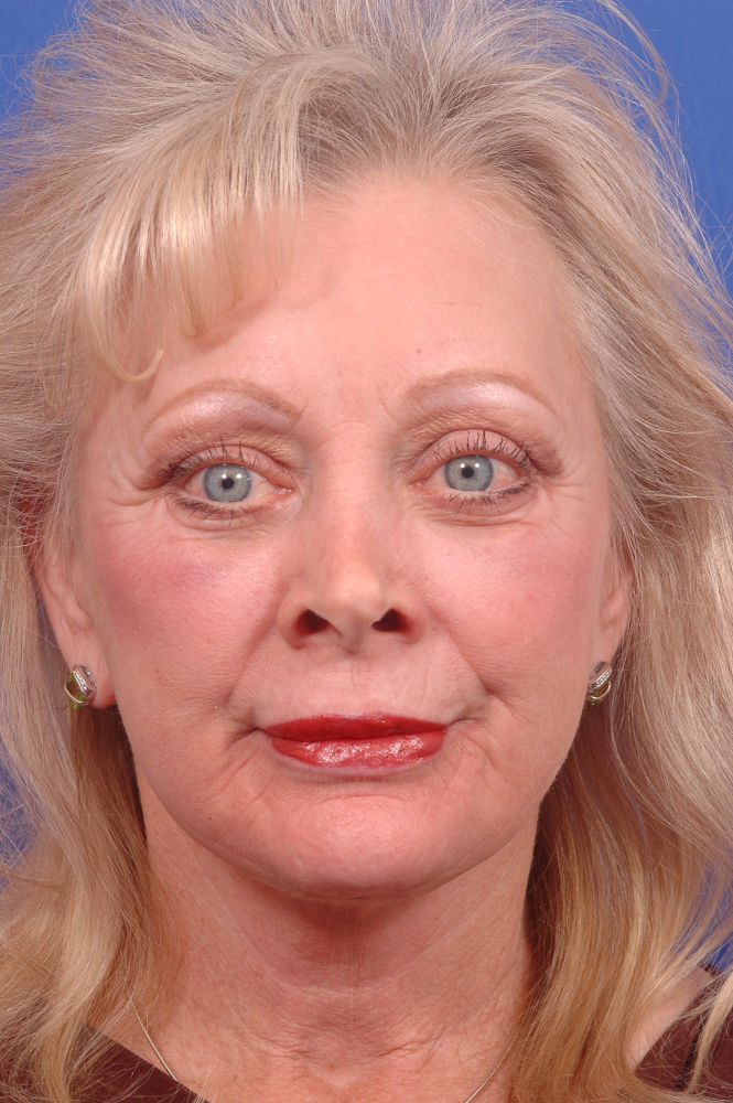 Before and After Photos Denver Plastic Surgery Gallery Dr. John Millard