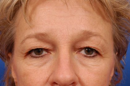 Brow Lift Before & After Patient #7790