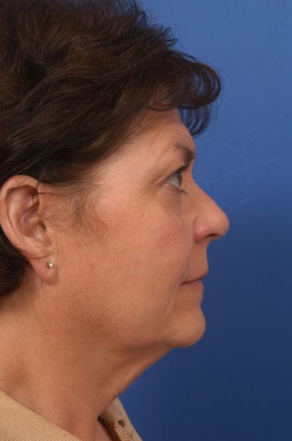 Facelift Before & After Patient #7785