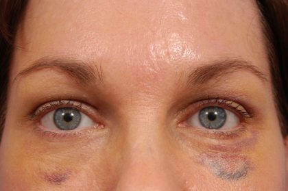 Brow Lift Before & After Patient #7782