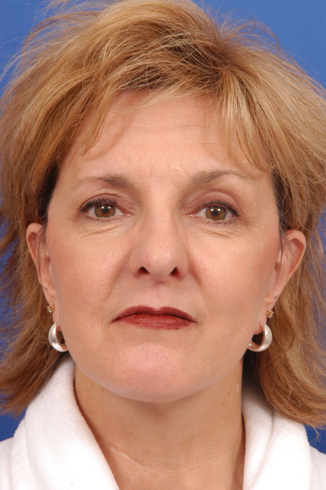 Before and After Photos Denver Plastic Surgery Gallery Dr. John Millard