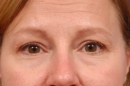 Brow Lift Before & After Patient #7758