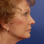 Facelift Before & After Patient #7818