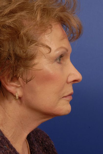 Facelift Before & After Patient #7818