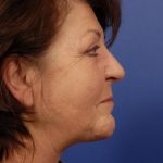 Facelift Before & After Patient #7813
