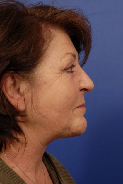 Facelift Before & After Patient #7813