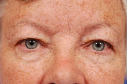Brow Lift Before & After Patient #7738