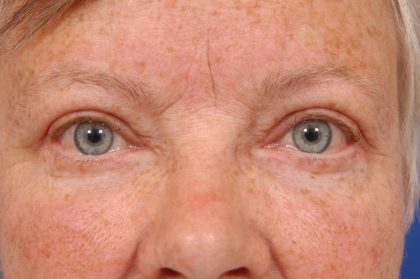 Brow Lift Before & After Patient #7738
