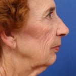 Facelift Before & After Patient #7808