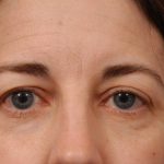 Brow Lift Before & After Patient #7733