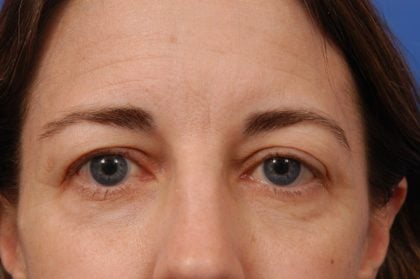 Brow Lift Before & After Patient #7733