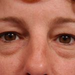 Brow Lift Before & After Patient #7728