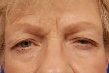 Brow Lift Before & After Patient #7723