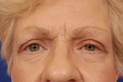 Brow Lift Before & After Patient #7723