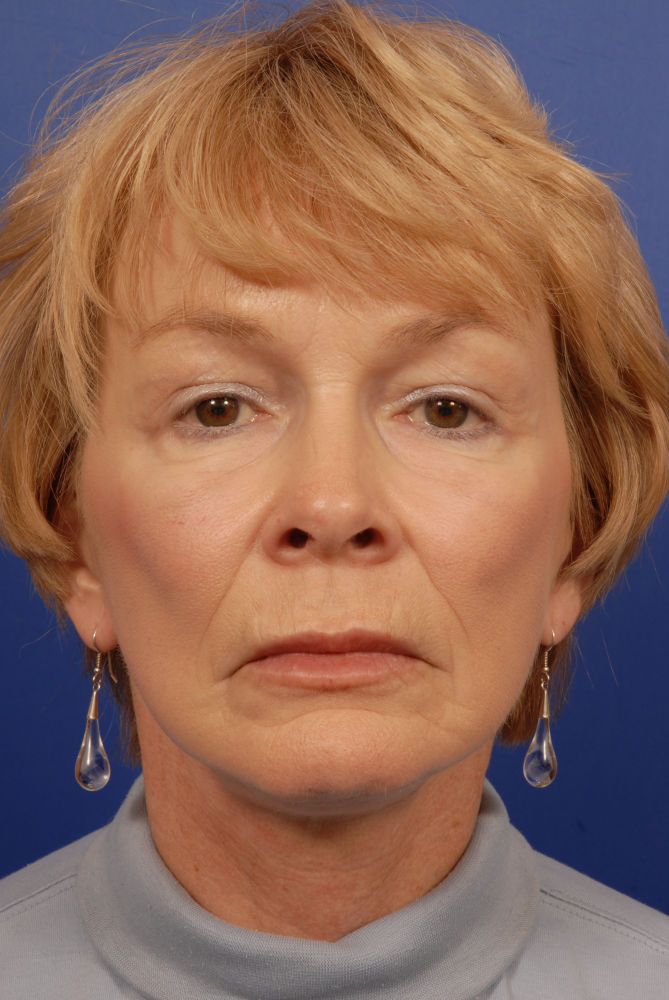 Before and After Photos Denver Plastic Surgery Gallery Dr. John Millard