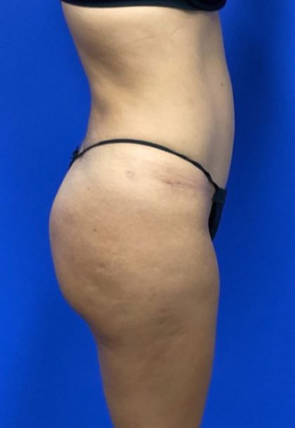 Brazilian Butt Lift Before & After Patient #8280
