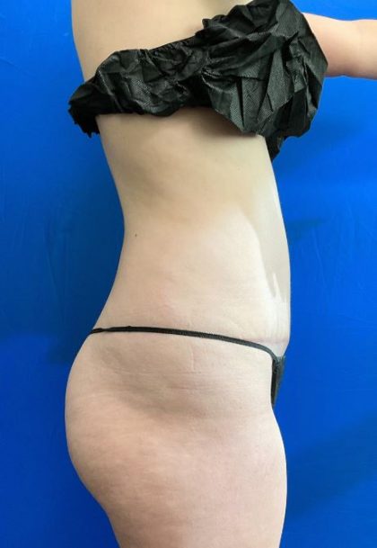 Tummy Tuck Before & After Patient #8334