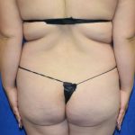 Brazilian Butt Lift Before & After Patient #8285