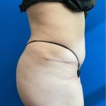 Brazilian Butt Lift Before & After Patient #8285