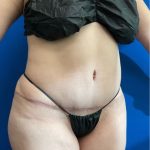 Tummy Tuck Before & After Patient #8335