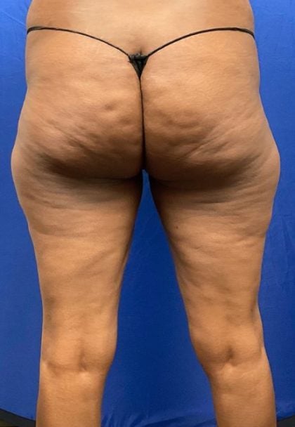 Legs Liposuction Before & After Patient #8316