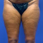 Legs Liposuction Before & After Patient #8316