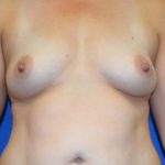 Breast Augmentation Before & After Patient #8304