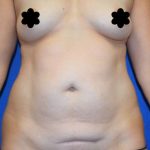 Tummy Tuck Before & After Patient #8336