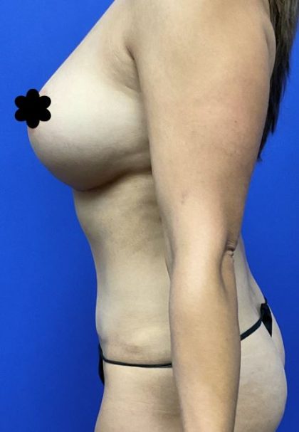 Tummy Tuck Before & After Patient #8336