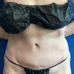 Tummy Tuck Before & After Patient #8337
