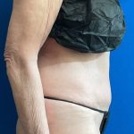 Tummy Tuck Before & After Patient #8337