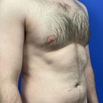Gynecomastia Before & After Patient #8321