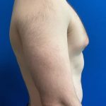Gynecomastia Before & After Patient #8321