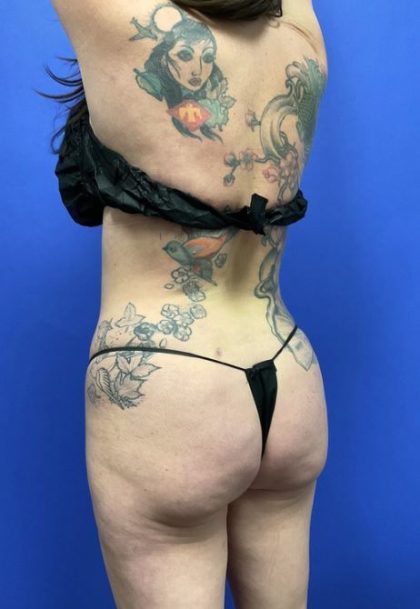 Brazilian Butt Lift Before & After Patient #8297
