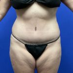 Tummy Tuck Before & After Patient #8338