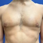 Gynecomastia Before & After Patient #8326