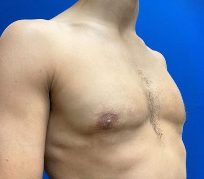 Gynecomastia Before & After Patient #8326